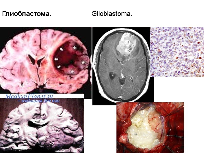 Глиобластома.             
